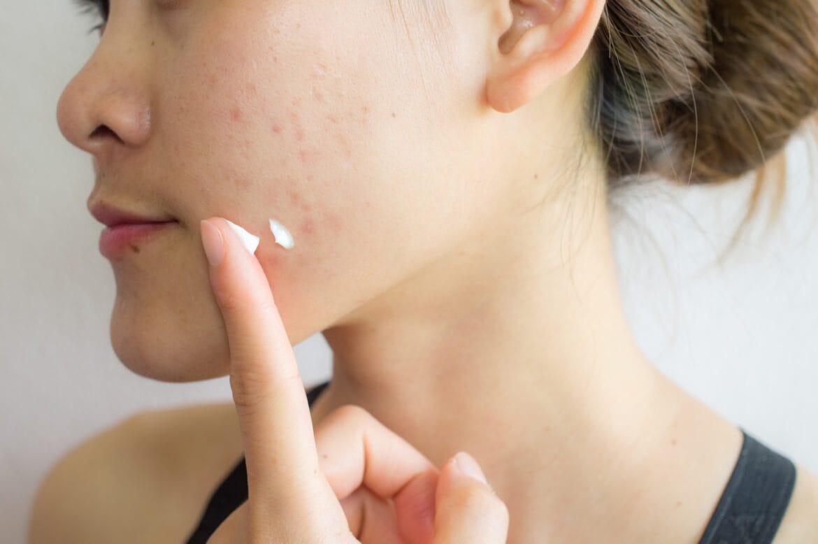 how to get rid of acne scars